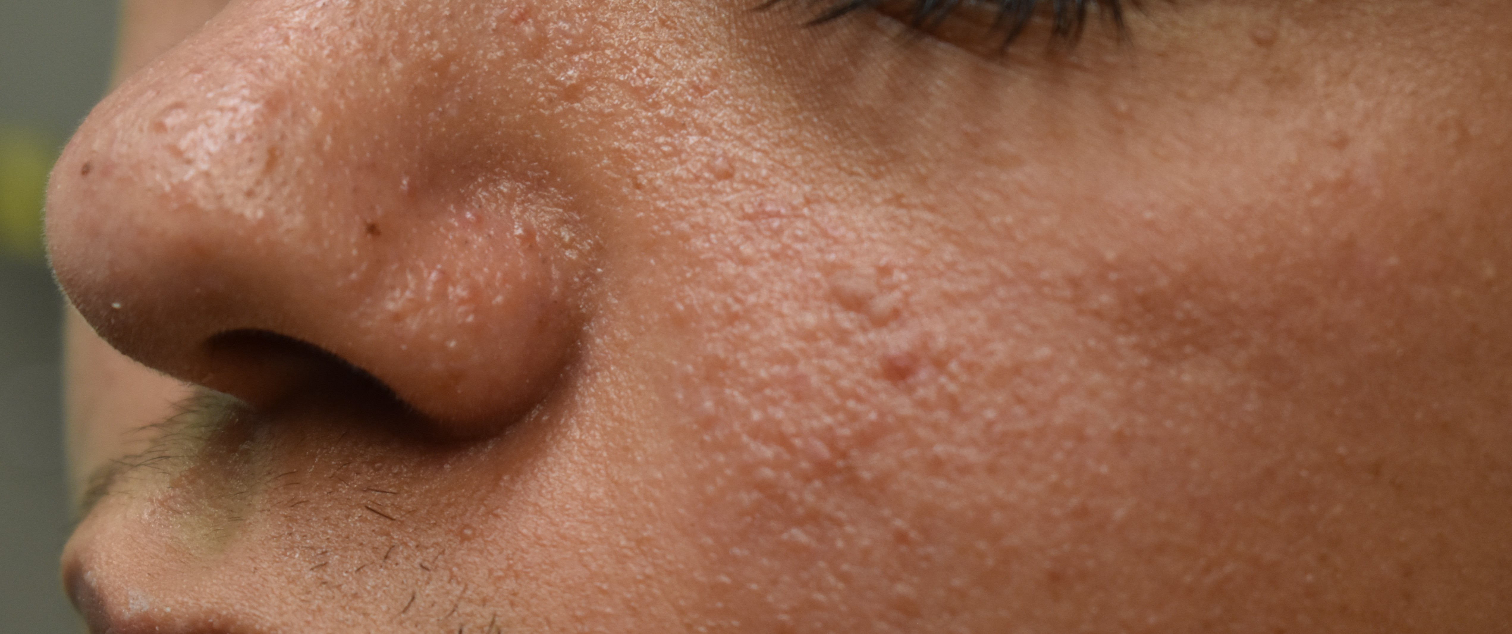 Tuberous Sclerosis 5a