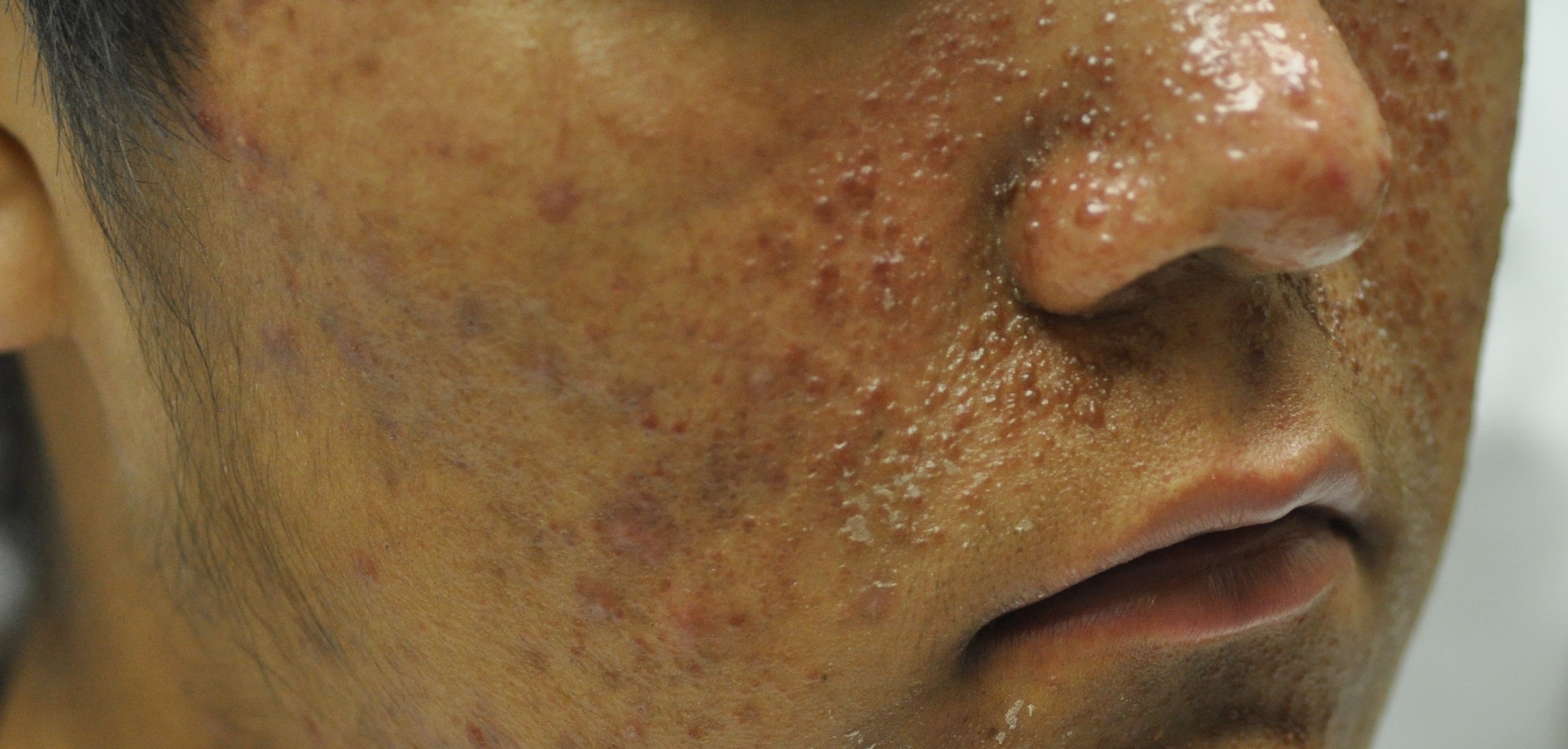 Tuberous Sclerosis 5b