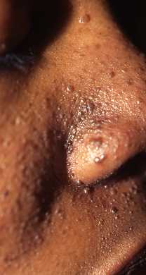 Tuberous Sclerosis 6a