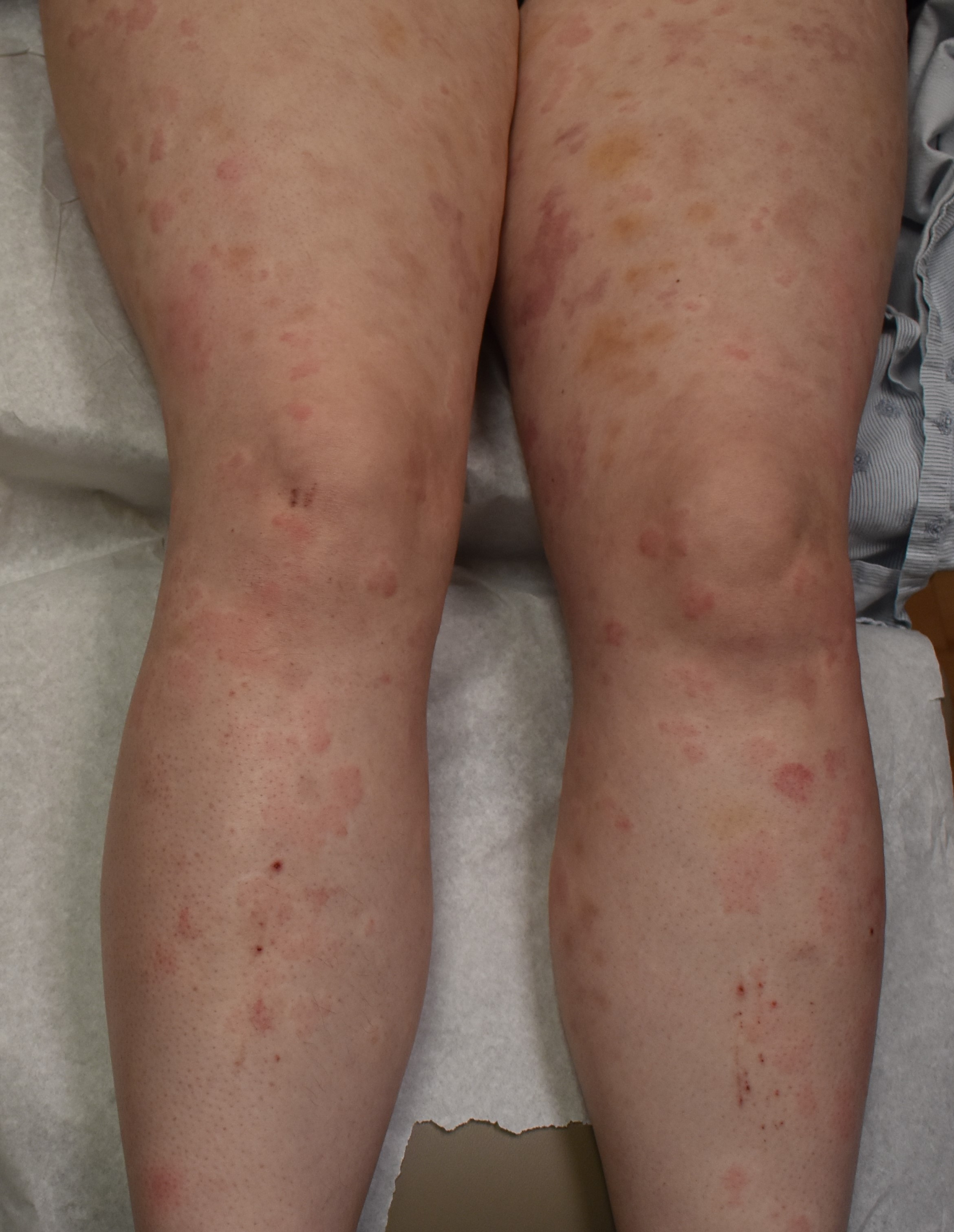 Urticaria 2a