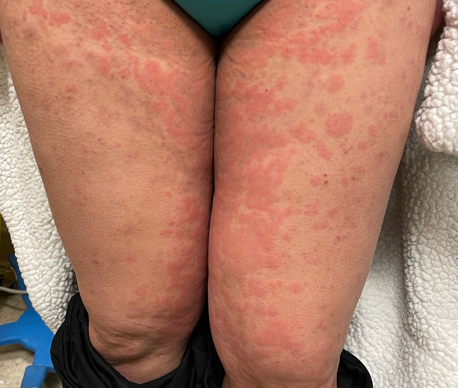 Urticaria 2b