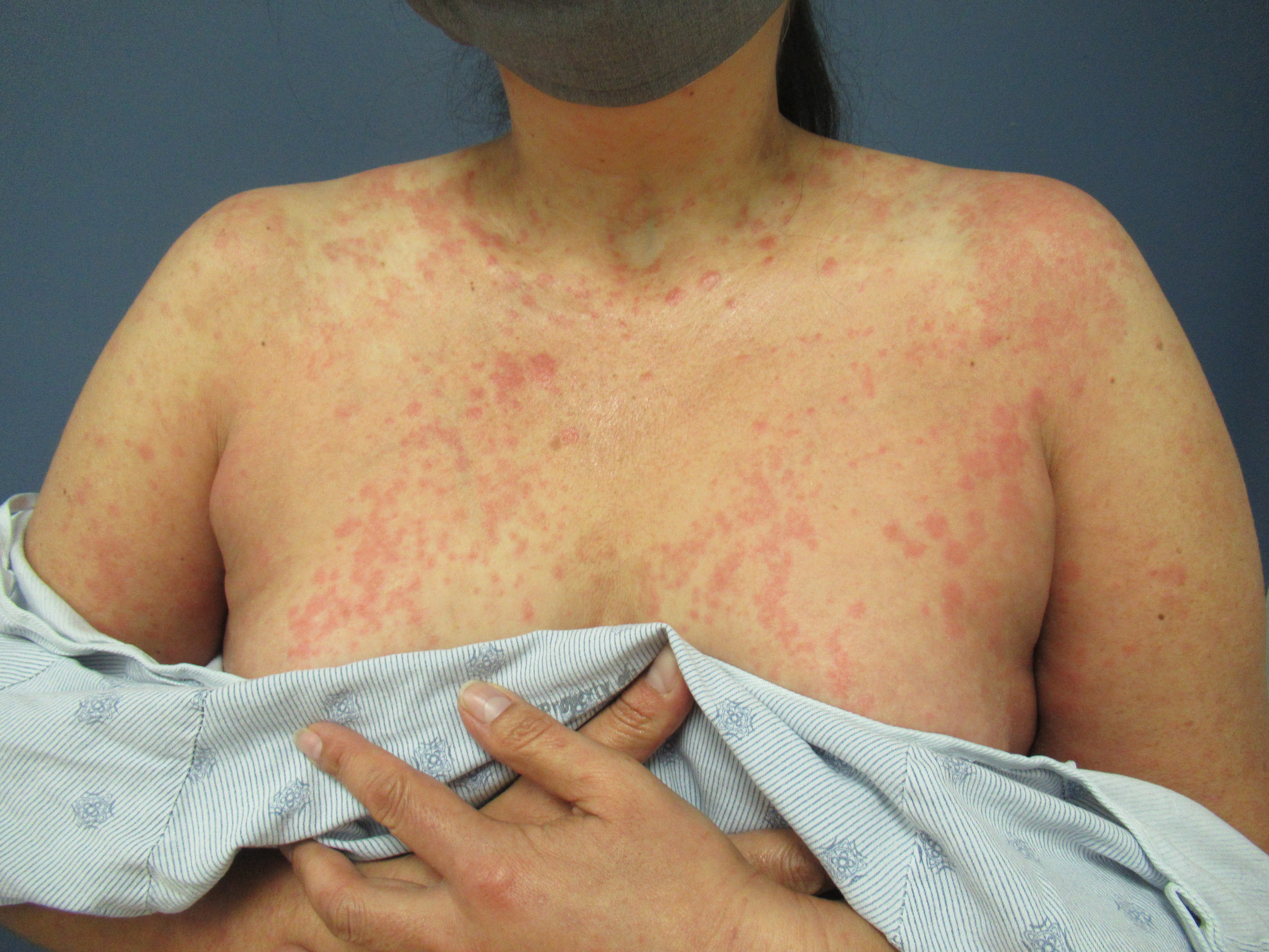 Urticaria 2c
