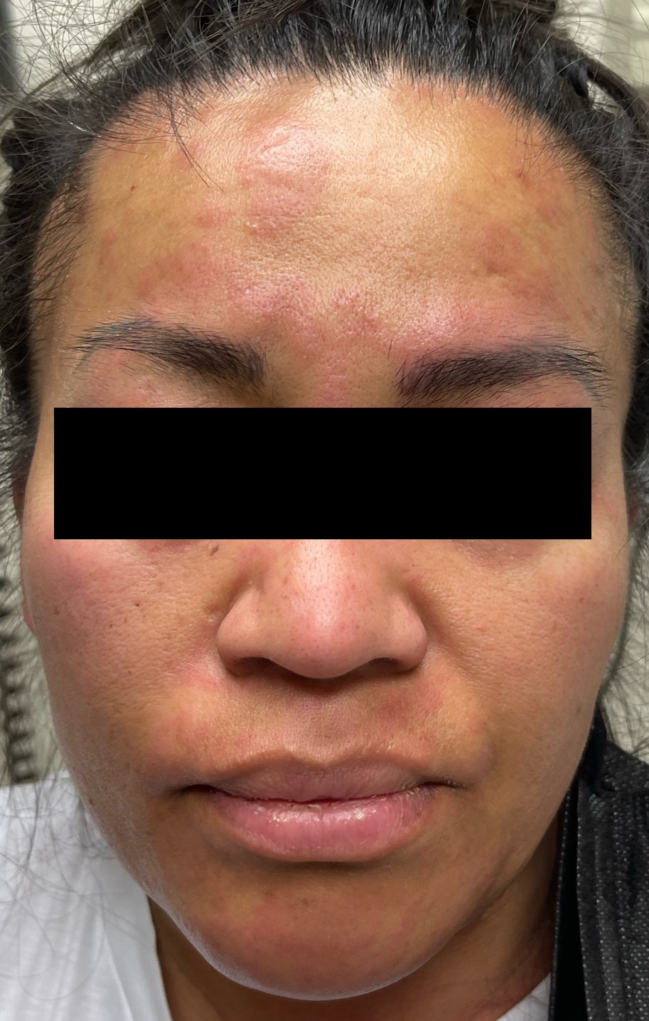 Urticaria 3b