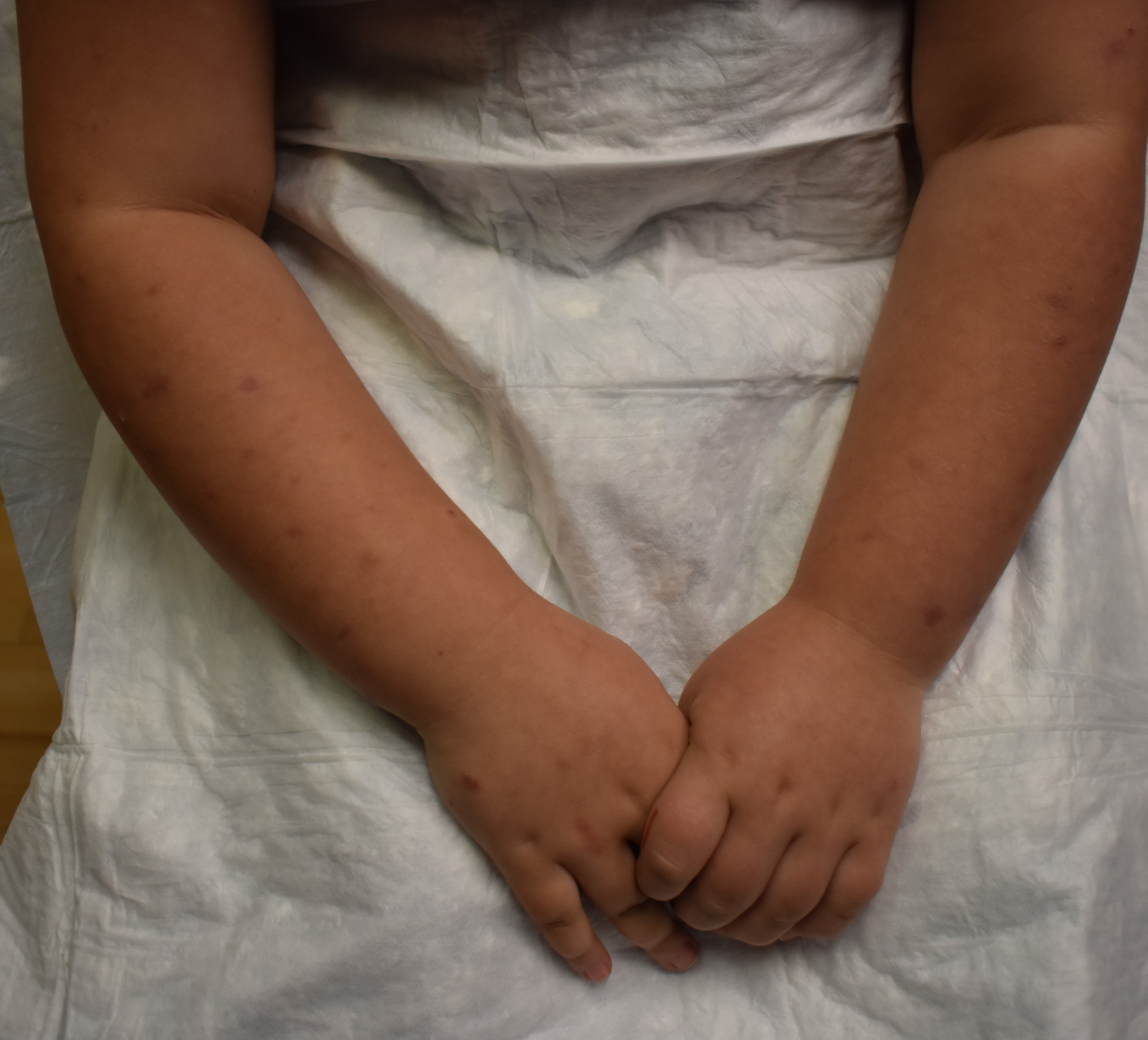 Urticaria 3c