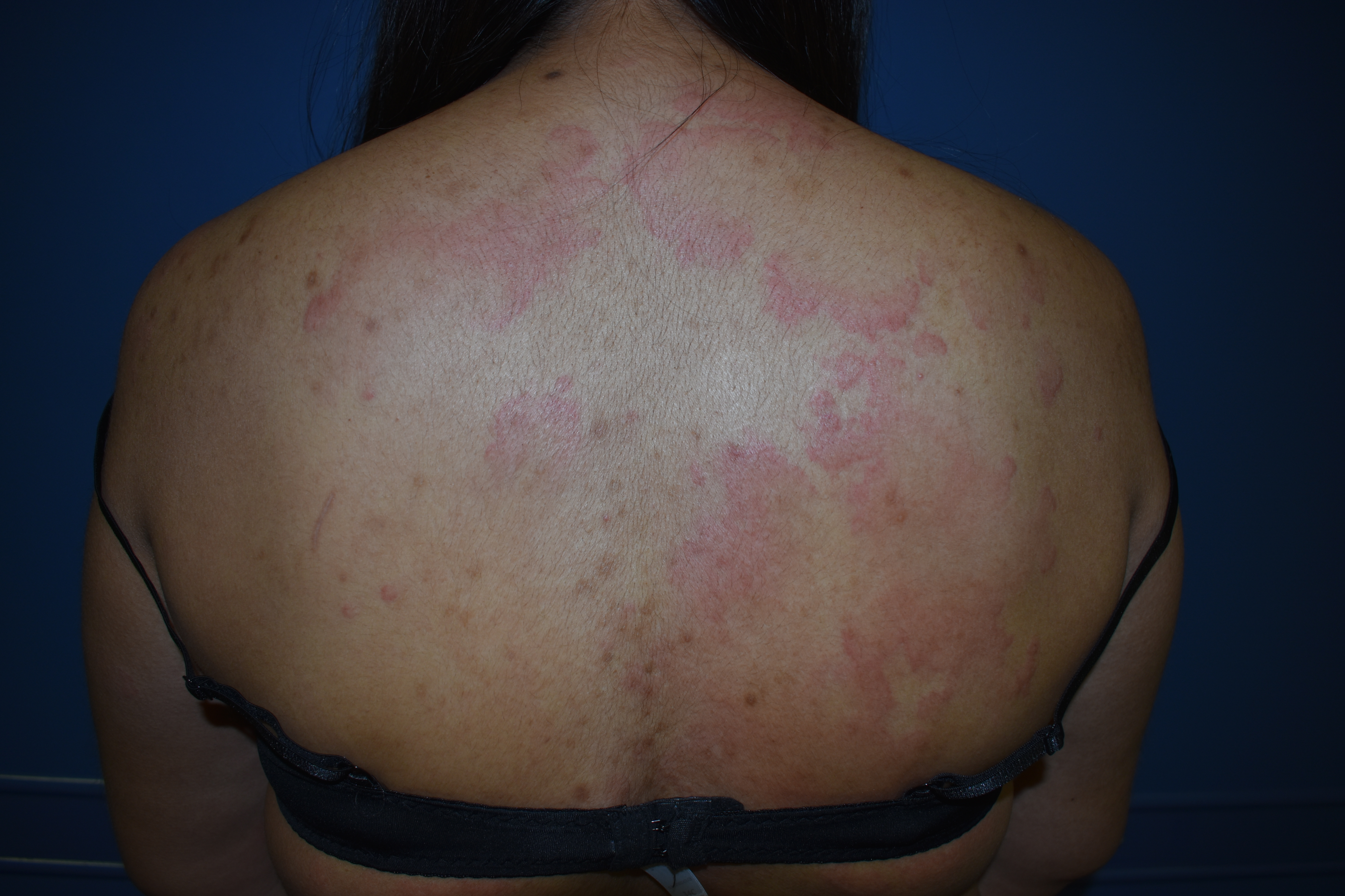 Urticaria