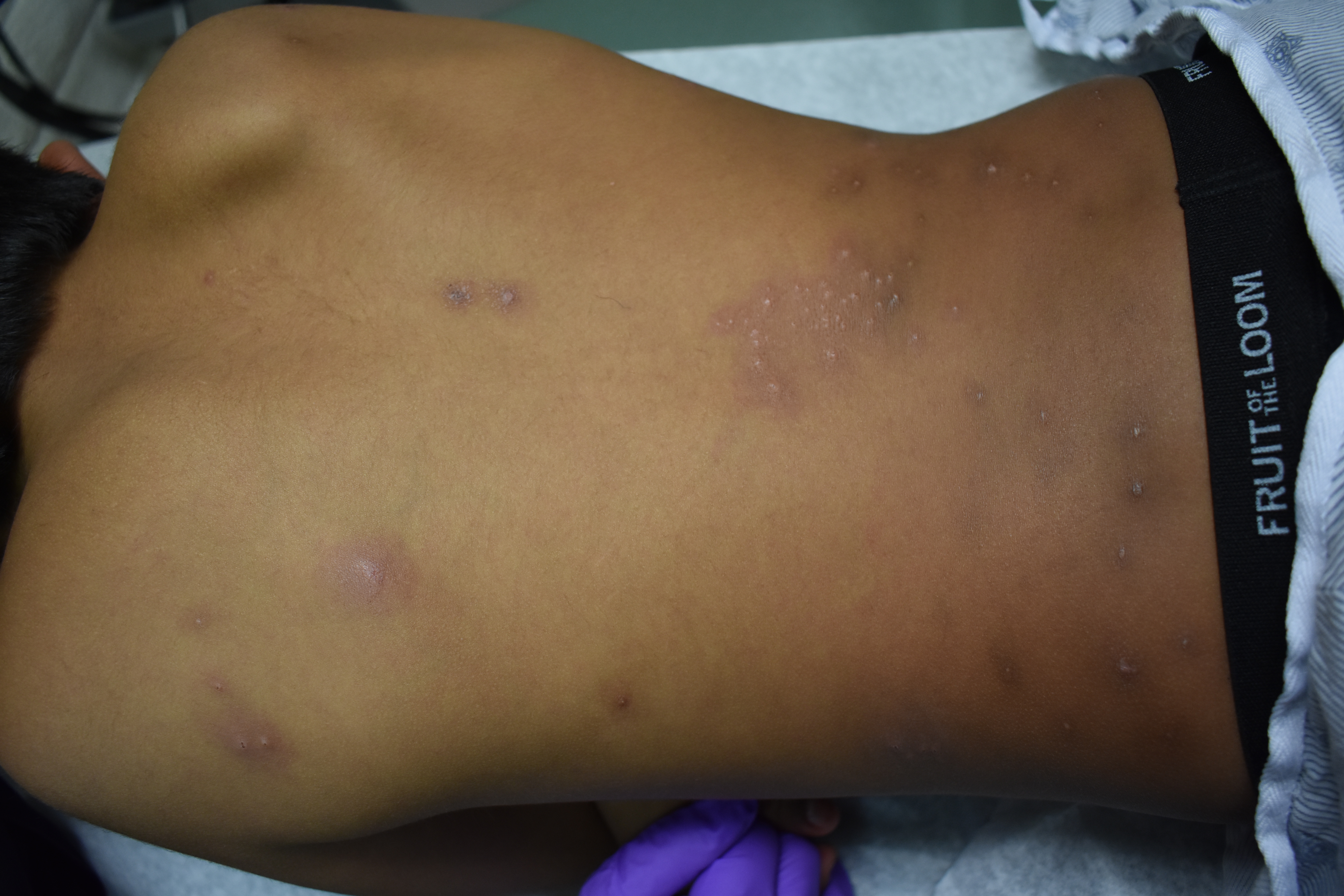 Urticaria 5a