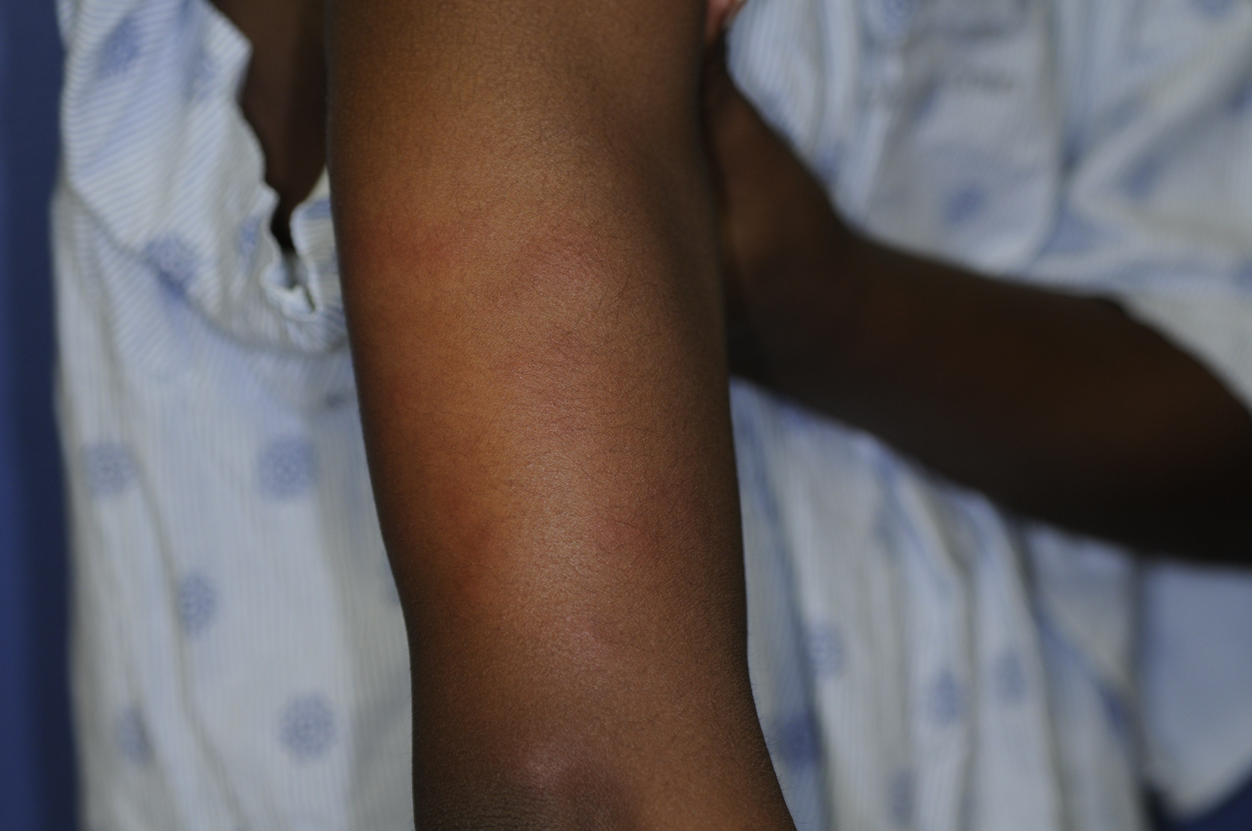 Urticaria 6b