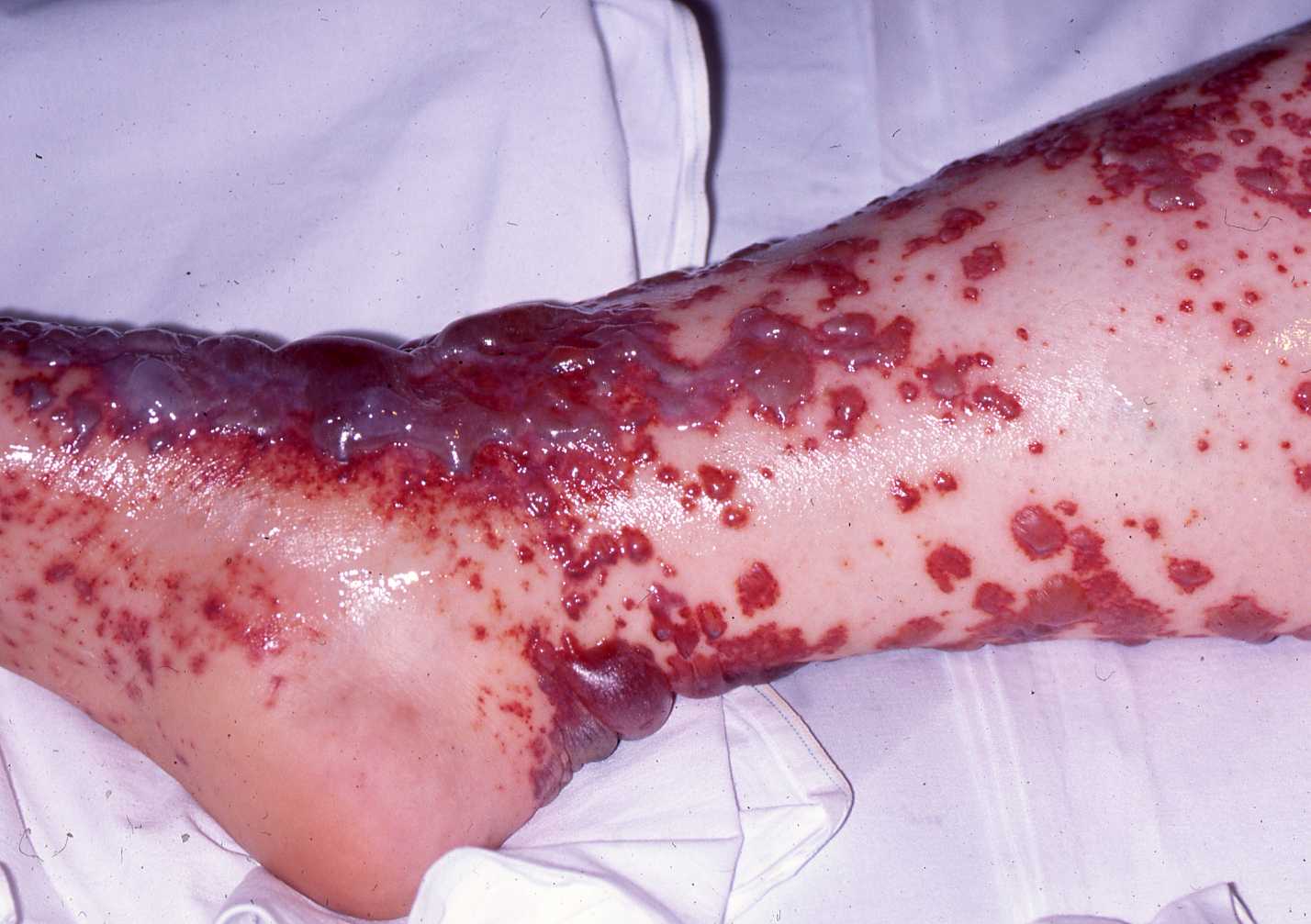 Vasculitis
