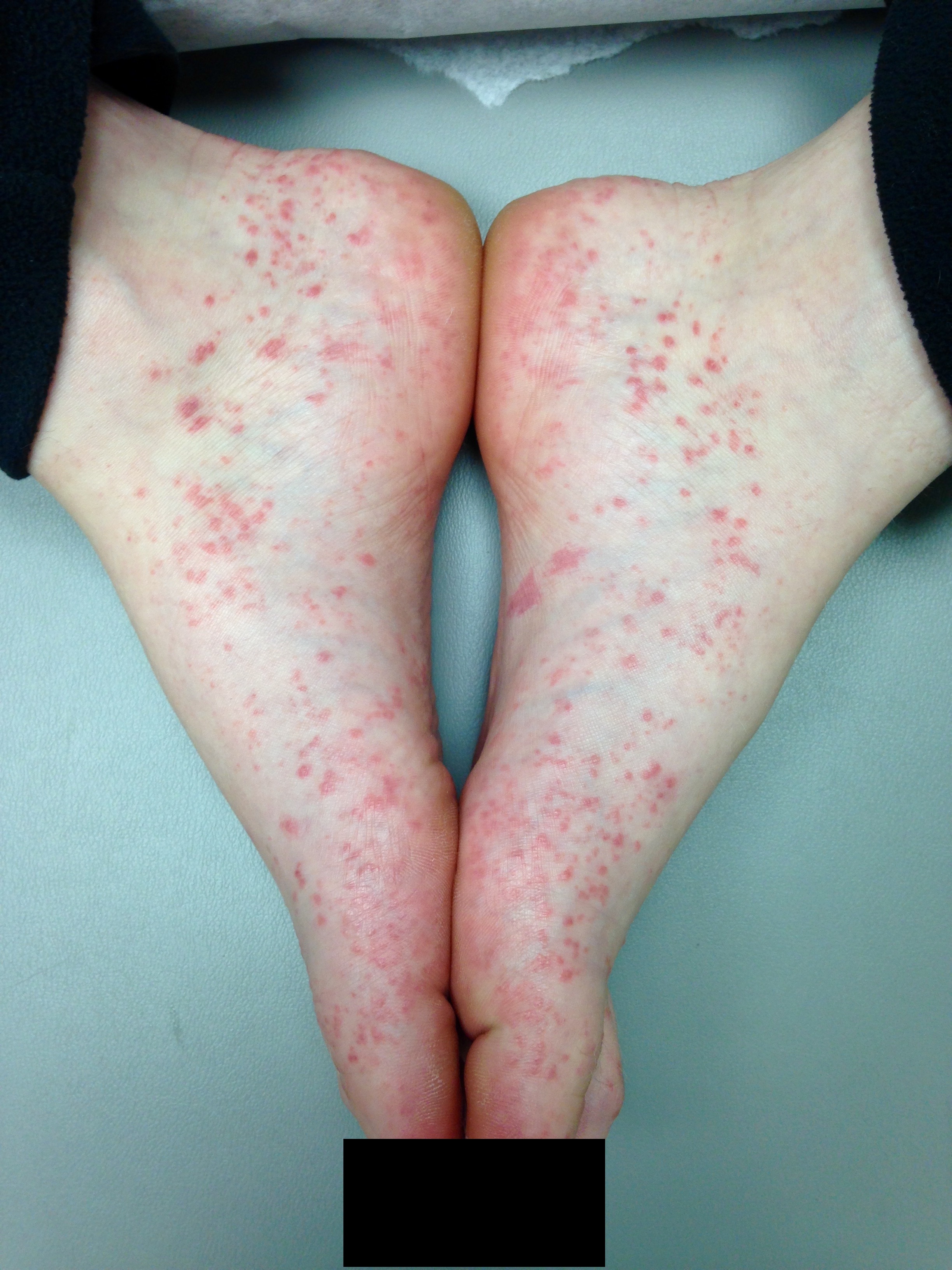 Vasculitis 1b