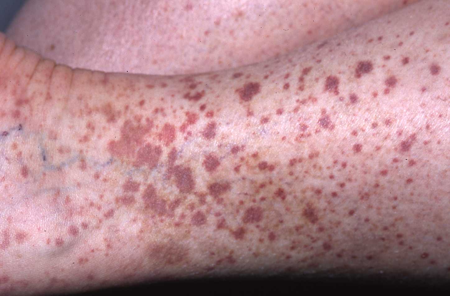 Vasculitis 2a