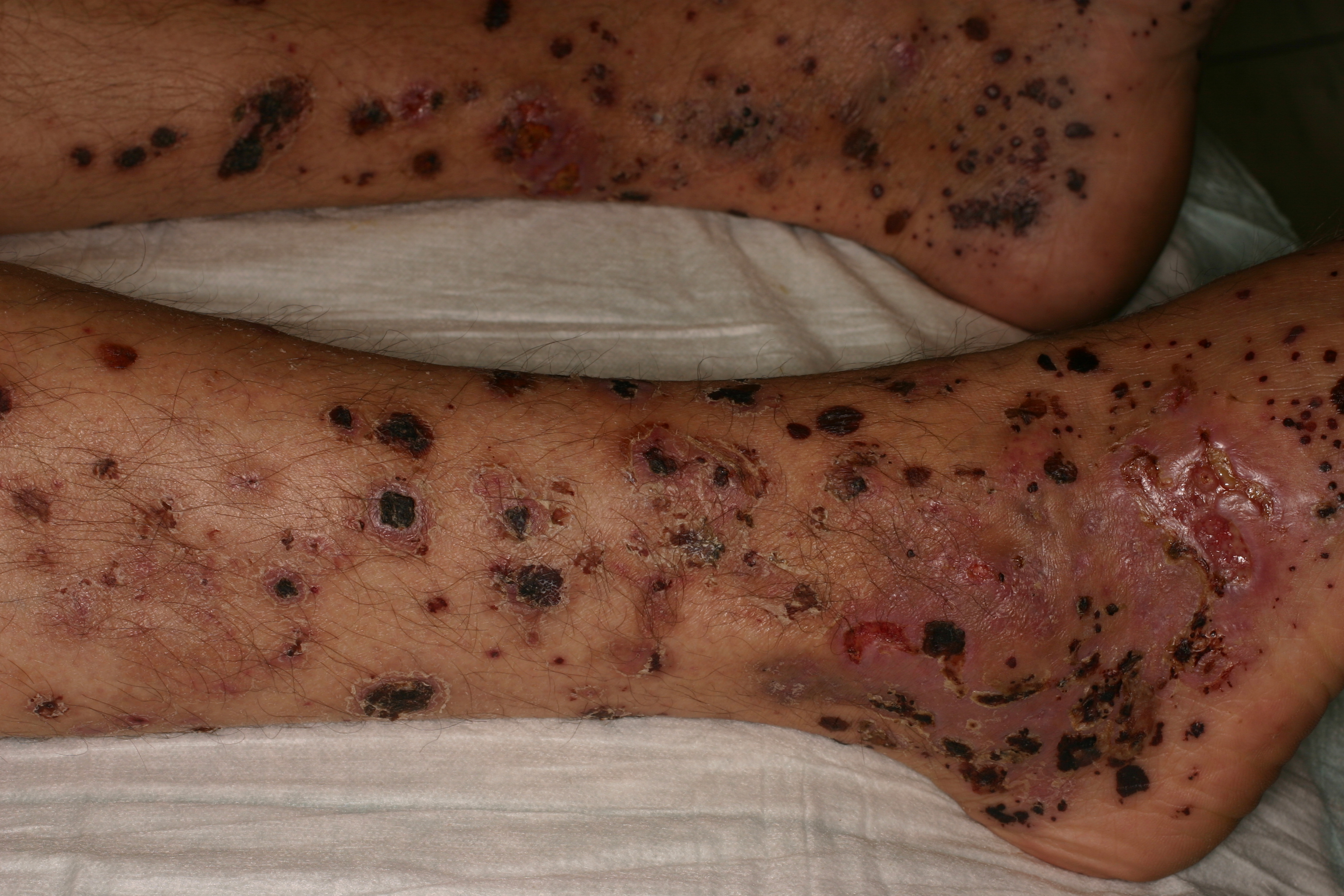 Vasculitis 2b