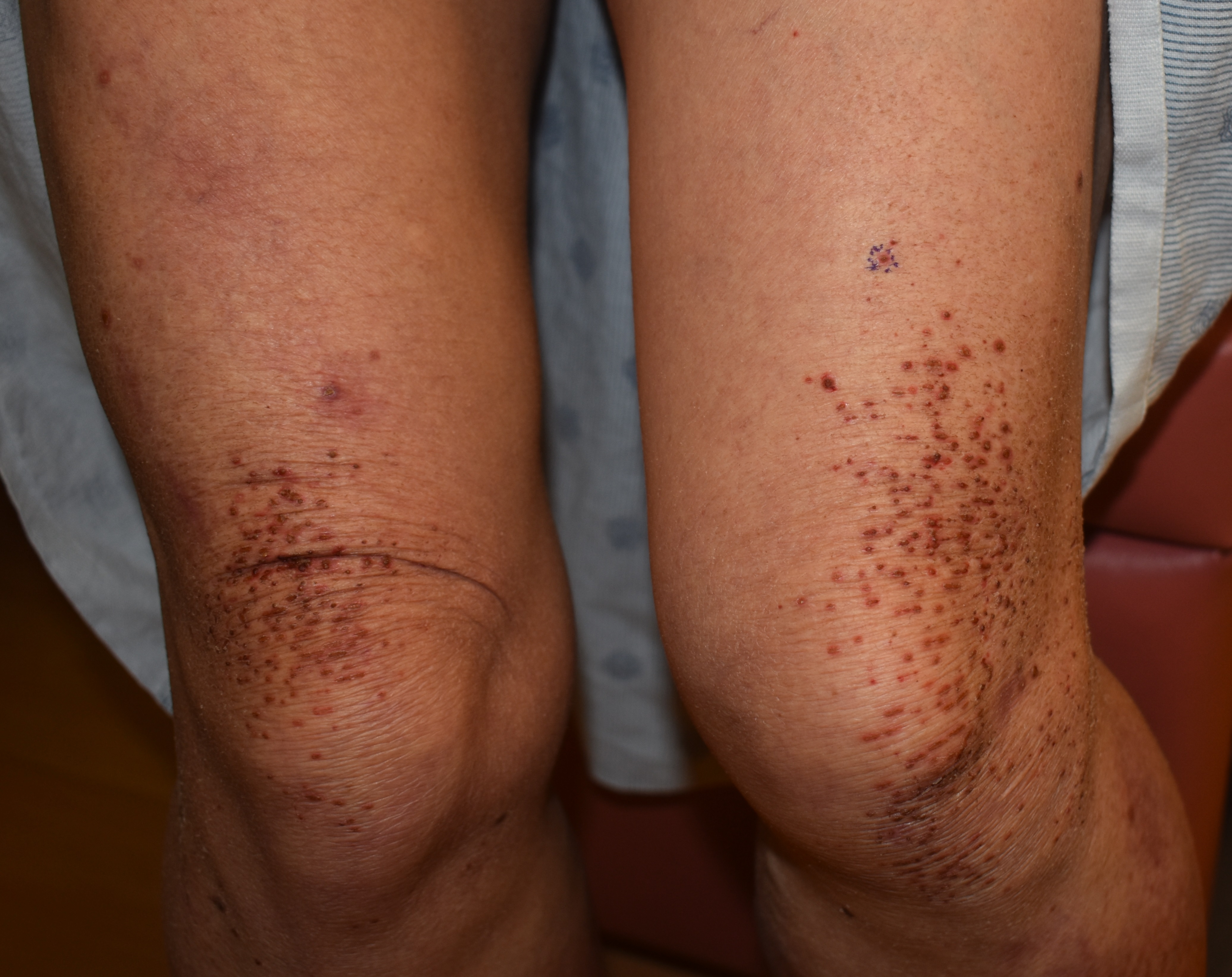 Vasculitis 3a
