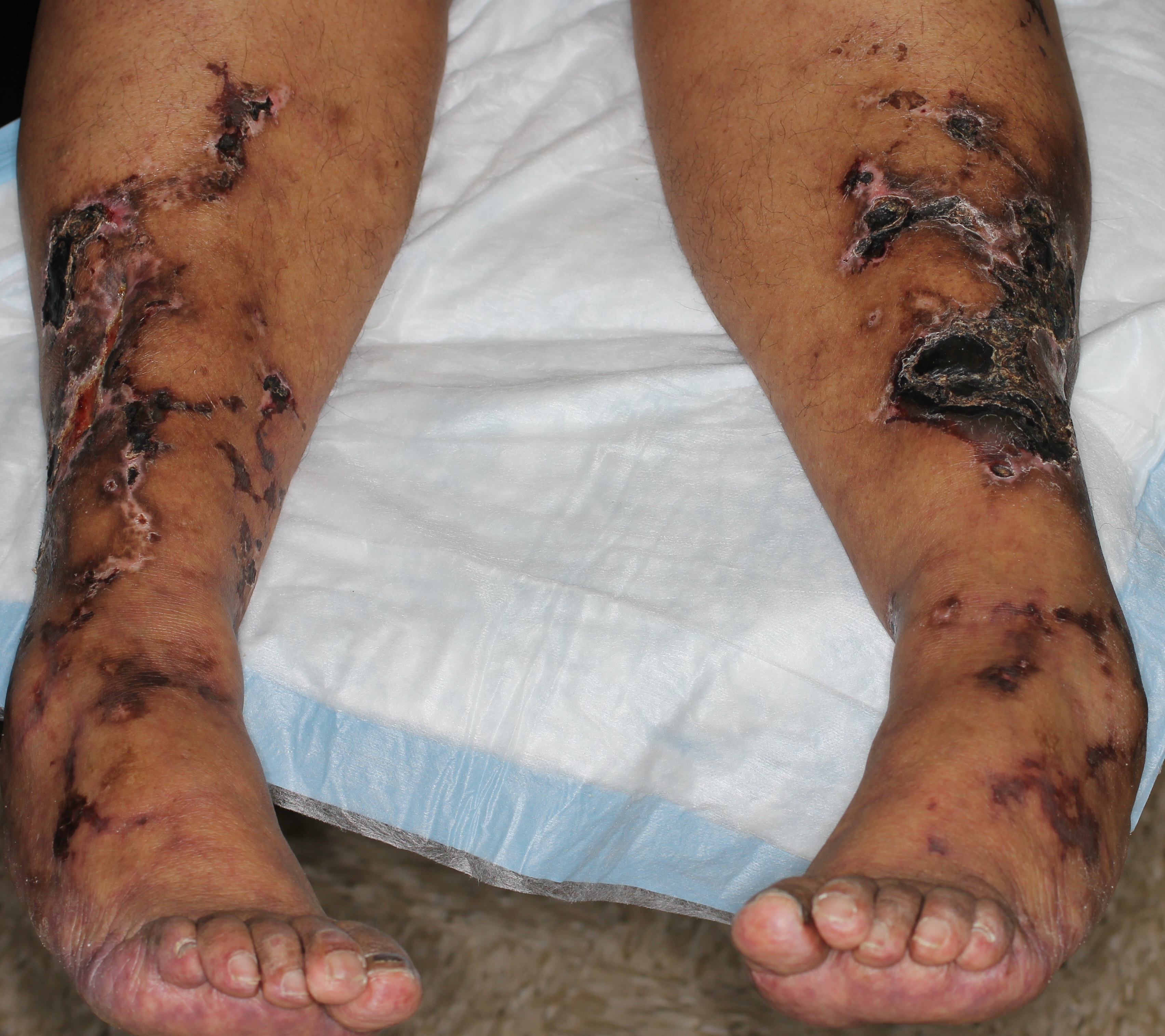 Vasculitis 4a