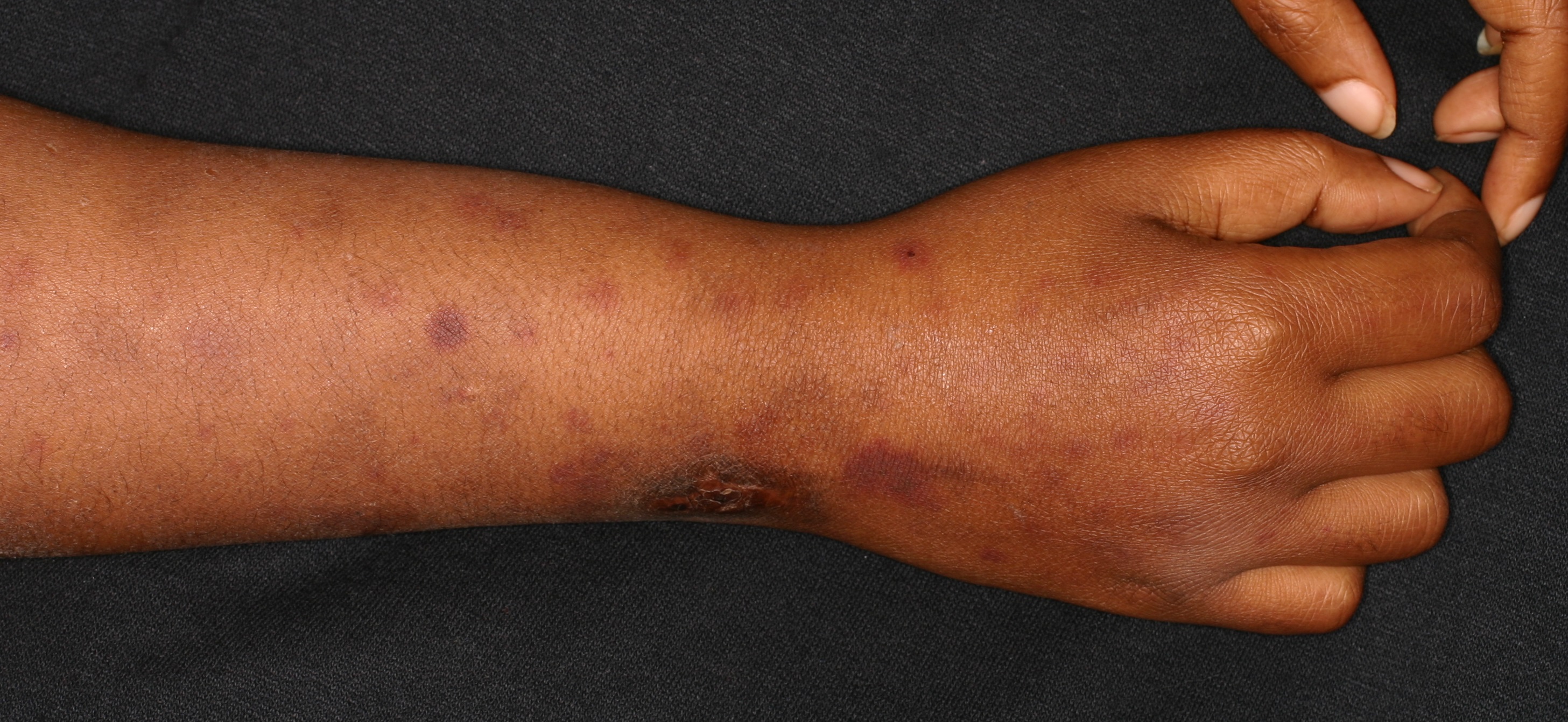 Vasculitis 5a