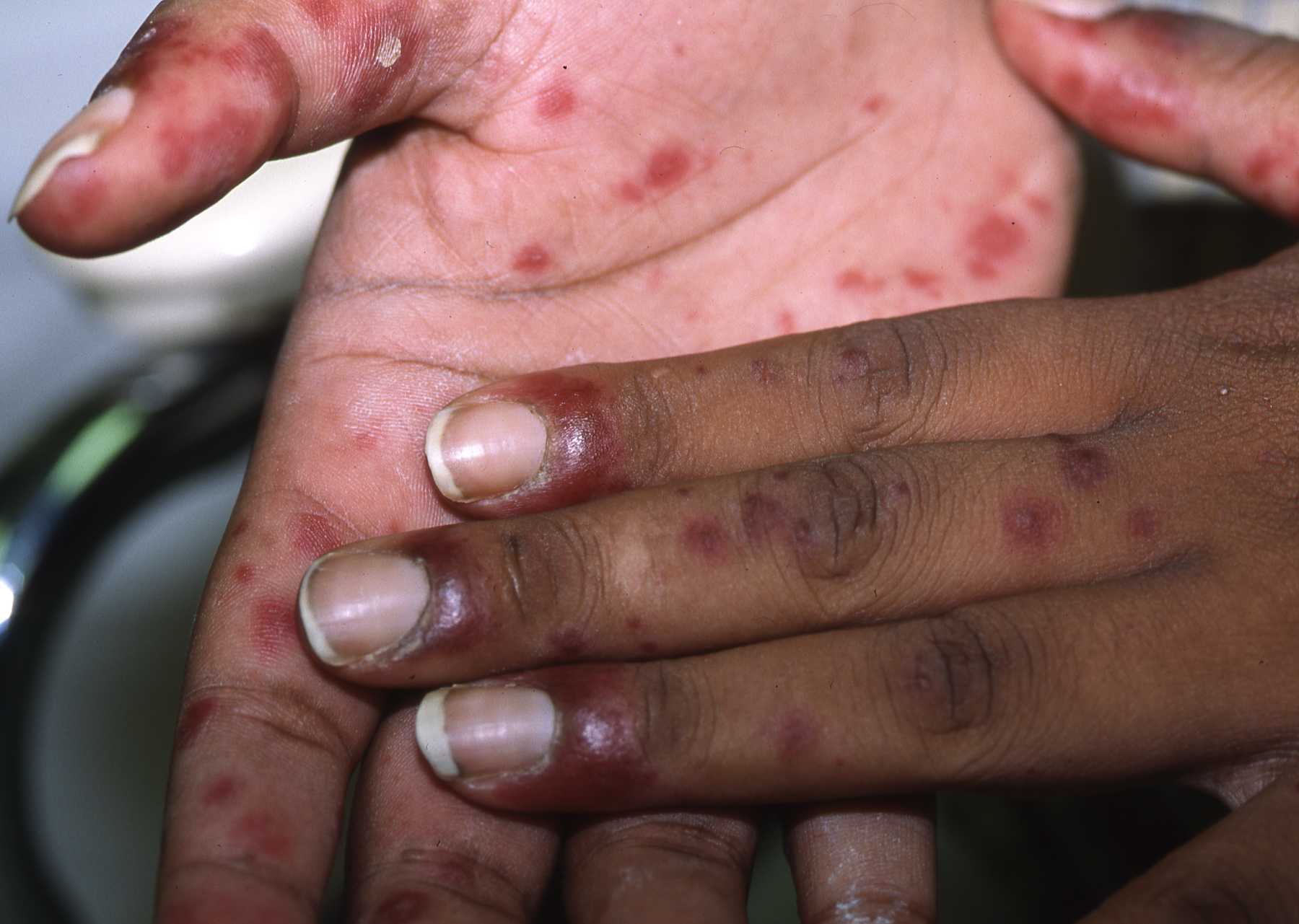 Vasculitis 5b