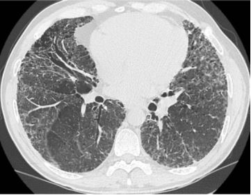 interessante Lungenröntgen