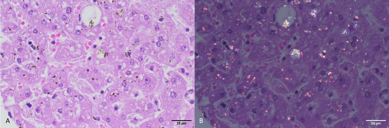 Polarization Wave Imaging of putative nano- and microplastics in human liver